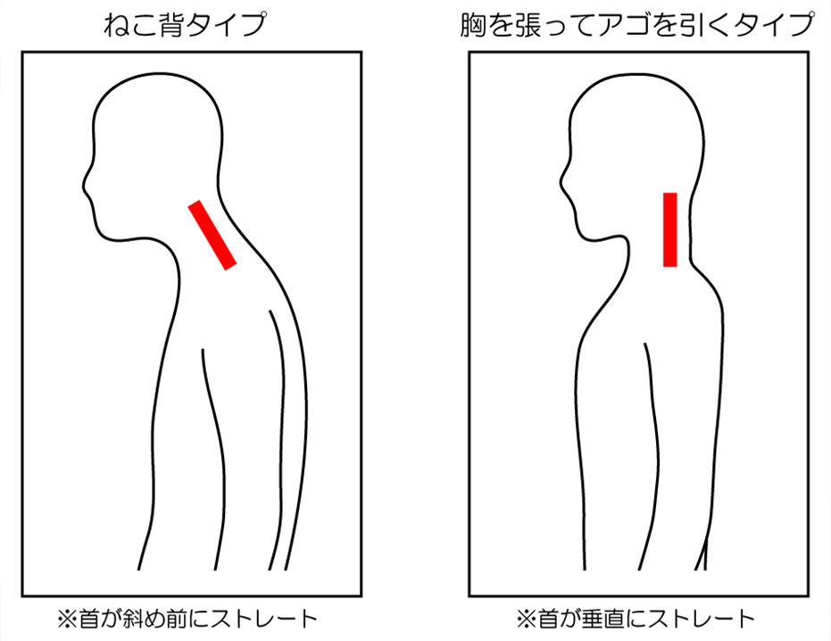 ～2種類のストレートネック～