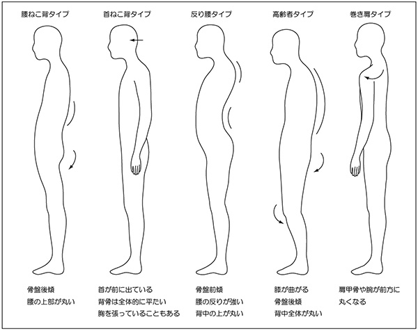 ねこ背　～ねこ背の種類について～